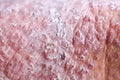 Atopic dermatitis AD, also known as atopic eczema, is a type of inflammation of the skin dermatitis. Royalty Free Stock Photo