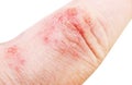 Atopic dermatitis (AD), also known as atopic eczema. Inflammation of the skin (dermatitis) on the fingers.