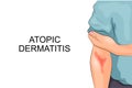 Atopic dermatitis. Allergy Royalty Free Stock Photo