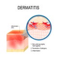 Atopic dermatitis atopic eczema Royalty Free Stock Photo