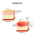 Atopic dermatitis eczema