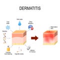 Atopic dermatitis atopic eczema. factors that cause disease. c