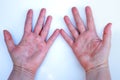 Atopic Dermatitis, Red hands, Dermatological problem, Female hands, Allergy and itching, Minimal concept, White background Royalty Free Stock Photo