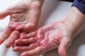 Atopic dermatitis. Red, itchy hands with blisters seen by a dermatologist Royalty Free Stock Photo