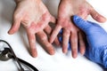 Atopic dermatitis. Red, itchy hands with blisters seen by a dermatologist wearing rubber gloves