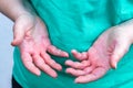 Atopic dermatitis, The woman looks at red and chapped hands with severe allergies