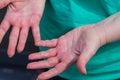 Atopic dermatitis, The woman looks at red and chapped hands with severe allergies Royalty Free Stock Photo