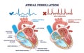 Atrial fibrillation as abnormal heart beat frequency disease outline diagram