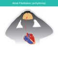 Atrial Fibrillation. Patients condition in which the electrical signals in heart malfunctioning or causing a short circuit in Royalty Free Stock Photo