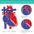 Atrial Septal Defect ASD and Ventricular Septal Defect VSD. Abnormal of the heart atrial and heart ventricle
