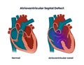 Atrioventricular septal defect. Illustration of the congenital heart anomaly