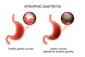 Atrophic gastritis. inflammation Royalty Free Stock Photo