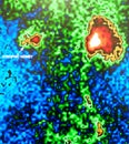 Atrophic kidney nuclear medicine