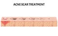 Atrophic scars. Acne scar. The anatomical structure of the skin with acne. Vector illustration on isolated background. Royalty Free Stock Photo