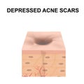 Atrophic scars. Acne scar. The anatomical structure of the skin with acne. Vector illustration on isolated background.