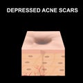 Atrophic scars. Acne scar. The anatomical structure of the skin with acne. Vector illustration on isolated background.