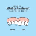 Attrition treatment comparison illustration vector on blue background. Dental concept.