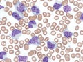 Atypical chronic lymphocytic leukemia in peripheral blood.