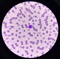 Atypical lympho cyte in red blood cell background Royalty Free Stock Photo