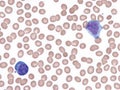 Cytomegalovirus infection. Peripheral blood smear.