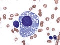 Atypical megakaryocyte in a case of myelodysplastic syndrome.