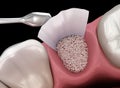 Augmentation Surgery - Adding bone after tooth extraction. 3D illustration