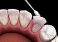 Augmentation Surgery - Adding bone after tooth extraction. 3D illustration