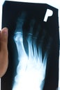 Authentic x-ray of foot Royalty Free Stock Photo