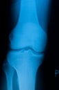 Authentic x-ray of male knee Royalty Free Stock Photo