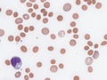 Autoimmune hemolytic anemia. Royalty Free Stock Photo