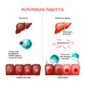 Autoimmune hepatitis Royalty Free Stock Photo