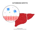 Autoimmune hepatitis disease