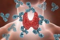 Autoimmune thyroiditis, Hashimoto`s disease