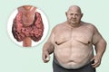 Autoimmune thyroiditis in obesity, conceptual 3D illustration showing an overweight patient and thyroid gland attacked by