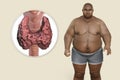 Autoimmune thyroiditis in obesity, conceptual 3D illustration showing an overweight patient and thyroid gland attacked