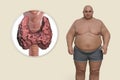 Autoimmune thyroiditis in obesity, conceptual 3D illustration showing an overweight patient and thyroid gland attacked