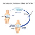 Autologous Chondrocyte Implantation Royalty Free Stock Photo