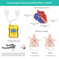 Automated External Defibrillator.