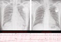 Automated implantable cardioverter defibrillator AICD and Permanent Pacemaker