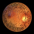 Autosomal dominant vitreoretinochoroidopathy, 3D illustration showing circular band of hyperpigmentation in the retina