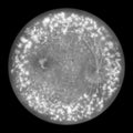 Autosomal dominant vitreoretinochoroidopathy, illustration showing hyperfluorescent lesions and leakage of lipofuscin