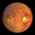 Autosomal recessive bestrophinopathy, ophthalmoscope view, 3D illustration showing accumulation of lipofuscin deposits