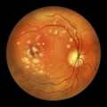 Autosomal recessive bestrophinopathy, ophthalmoscope view, scientific illustration showing accumulation of lipofuscin