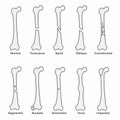 Types of fractures, broken bones
