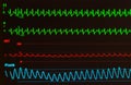 AVNRT Rhythm Strip