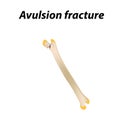 Avulsion fracture Bone. Infographics. Vector illustration on a lined background. Royalty Free Stock Photo
