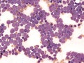 B-cell acute lymphoblastic leukemia in bone marrow. Royalty Free Stock Photo