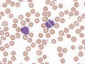 B-cell prolymphocytic leukemia with binucleated lymphocytes. Peripheral blood. Royalty Free Stock Photo