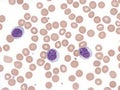 B-cell prolymphocytic leukemia with binucleated lymphocytes. Peripheral blood. Royalty Free Stock Photo
