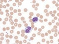 B-cell prolymphocytic leukemia with binucleated lymphocytes. Peripheral blood. Royalty Free Stock Photo